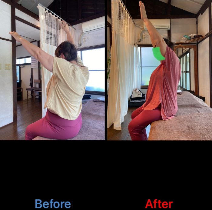 加圧トレーニング：６０代女性肩痛の場合